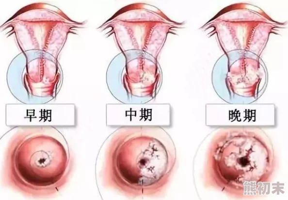 HPV1627.8在宫颈癌患者中的流行病学特征及其与临床病理因素的相关性研究